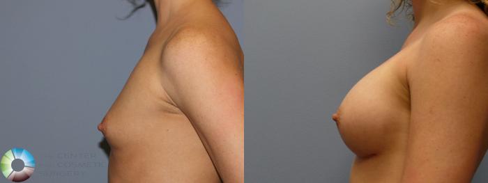 Before & After Breast Augmentation Case 999 View #3 View in Golden, CO