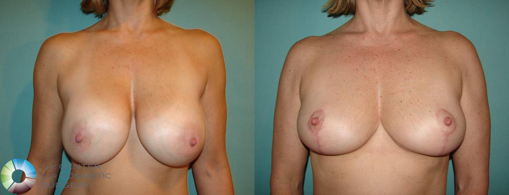 Before & After Breast Implant Removal (Explant) Case 10864 view-1 in Denver, CO