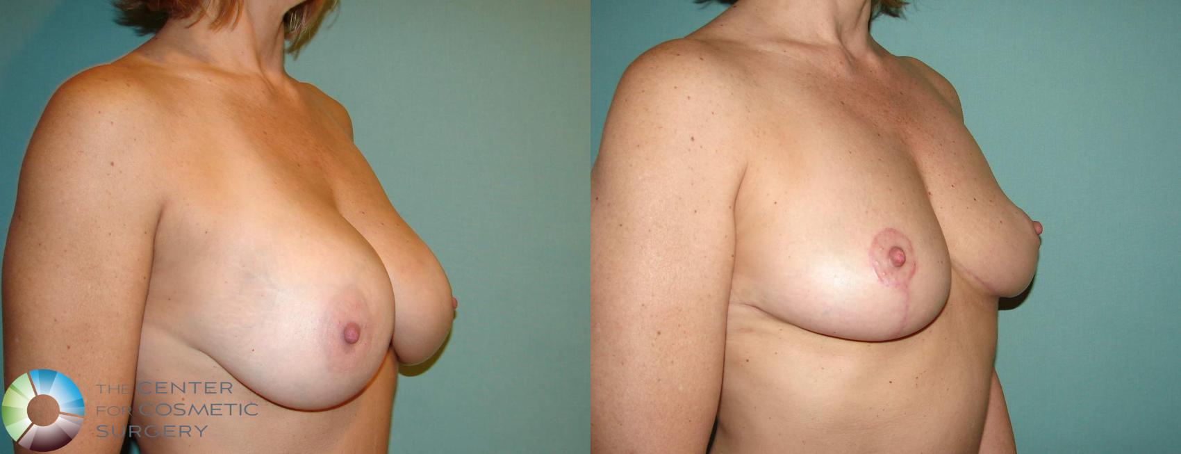 Before & After Breast Implant Removal (Explant) Case 10864 view-2 in Denver and Colorado Springs, CO