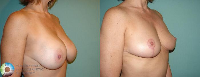 Before & After Breast Implant Removal (Explant) Case 10864 view-2 View in Golden, CO