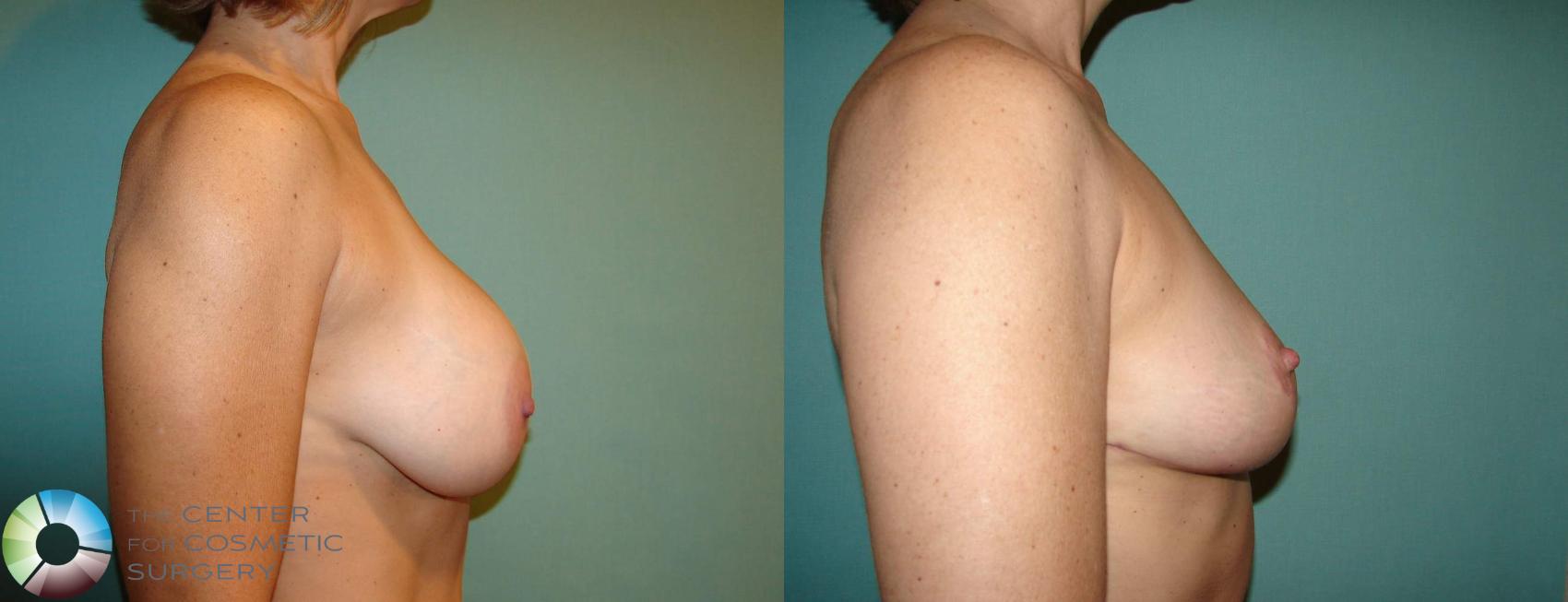 Before & After Breast Implant Removal (Explant) Case 10864 view-3 in Denver and Colorado Springs, CO