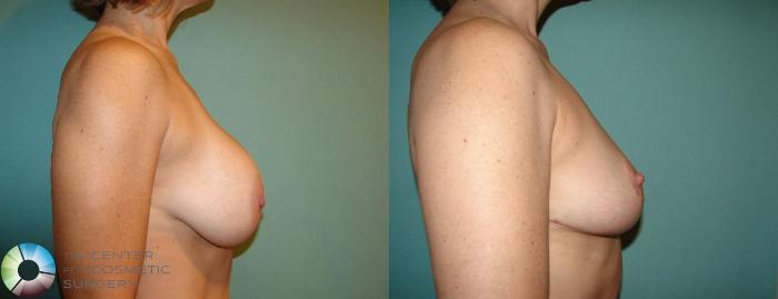 Before & After Breast Implant Removal (Explant) Case 10864 view-3 View in Golden, CO