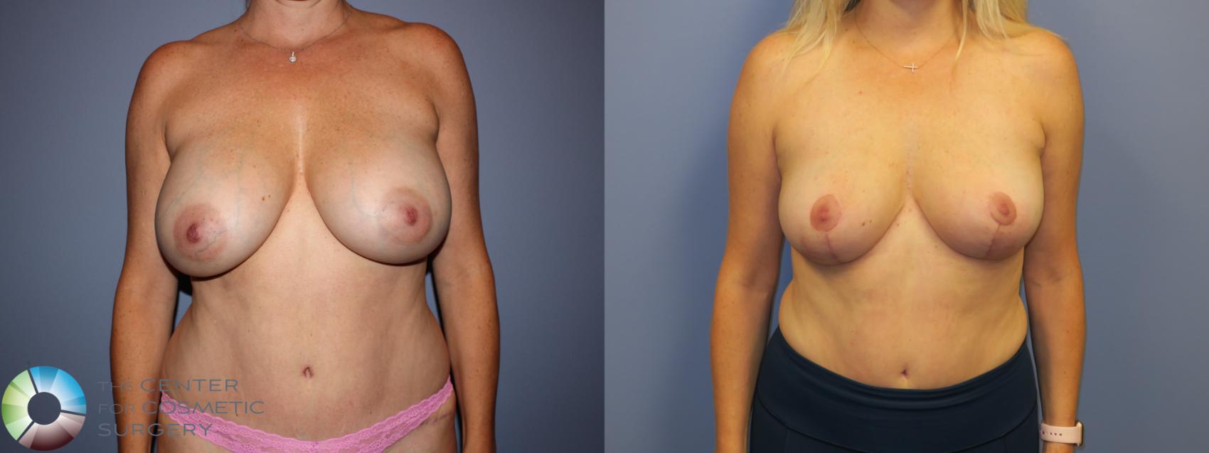 Before & After Breast Implant Removal (Explant) Case 11214 Front in Denver and Colorado Springs, CO