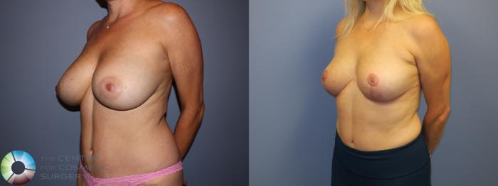 Before & After Breast Lift without Implants Case 11214 Left Oblique View in Golden, CO
