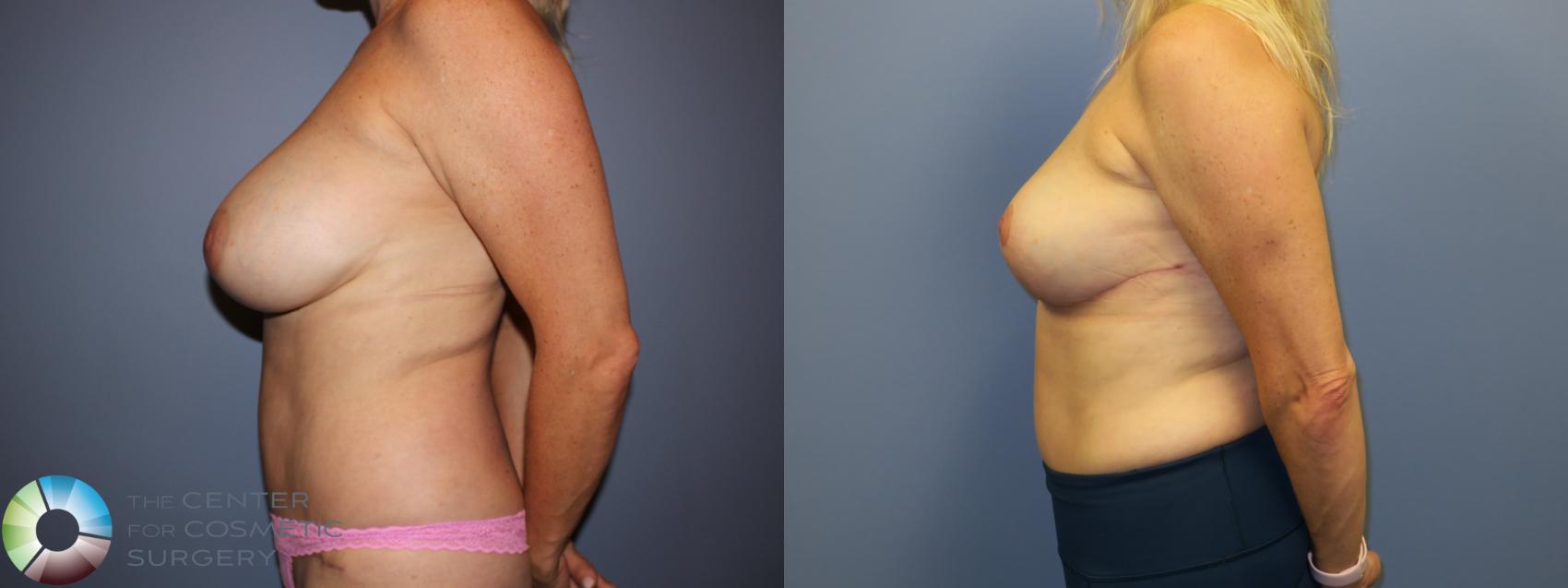 Before & After Breast Implant Removal (Explant) Case 11214 Left Side View in Golden, CO