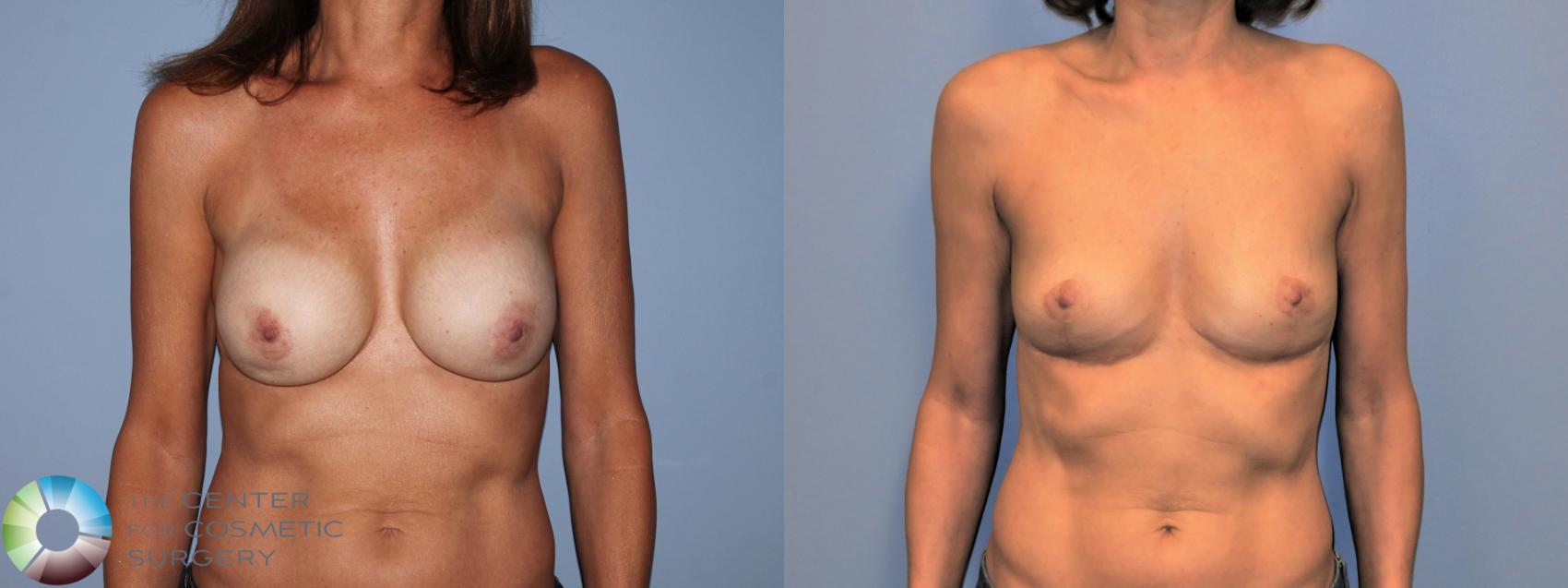 Before & After Breast Implant Revision Case 11215 Front in Denver and Colorado Springs, CO