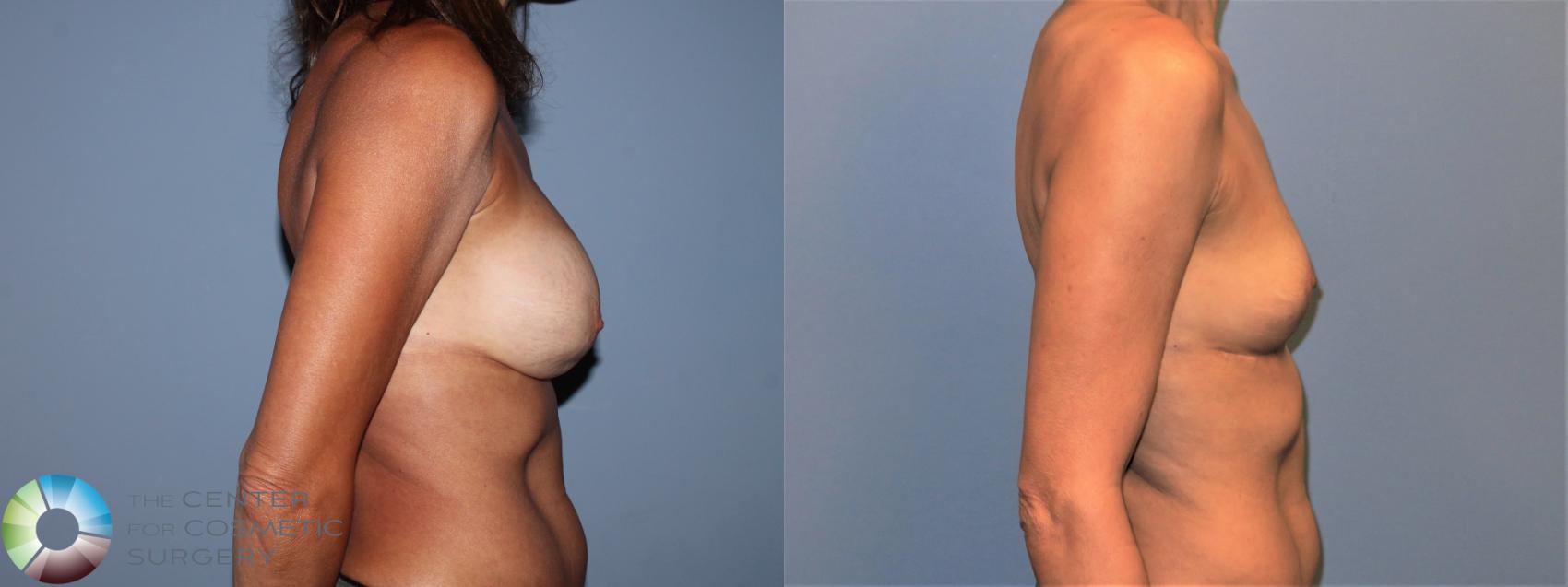 Before & After Breast Implant Removal (Explant) Case 11215 Right Side View in Golden, CO