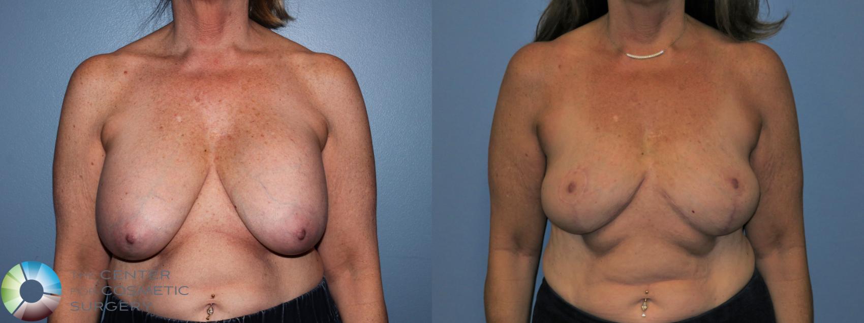 Before & After Breast Implant Removal (Explant) Case 11217 Front in Denver and Colorado Springs, CO