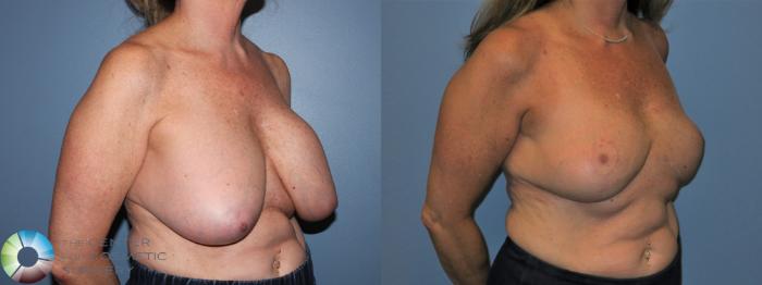Breast Implant Removal with Capsulectomy and Breast Lift