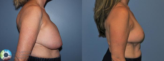 Before & After Breast Implant Revision Case 11217 Right Side View in Golden, CO