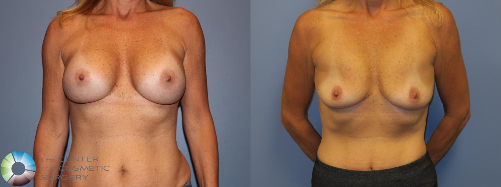 Before & After Breast Implant Removal (Explant) Case 11221 Front in Denver and Colorado Springs, CO