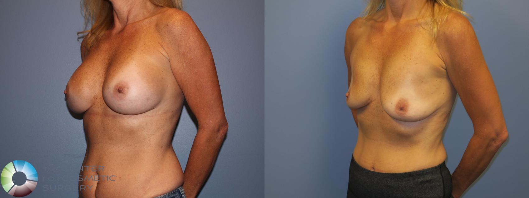 Before & After Breast Implant Removal (Explant) Case 11221 Left Oblique View in Golden, CO