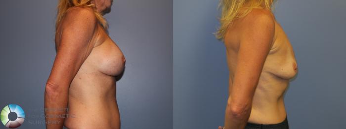 Before & After Breast Implant Removal (Explant) Case 11221 Right Side View in Golden, CO
