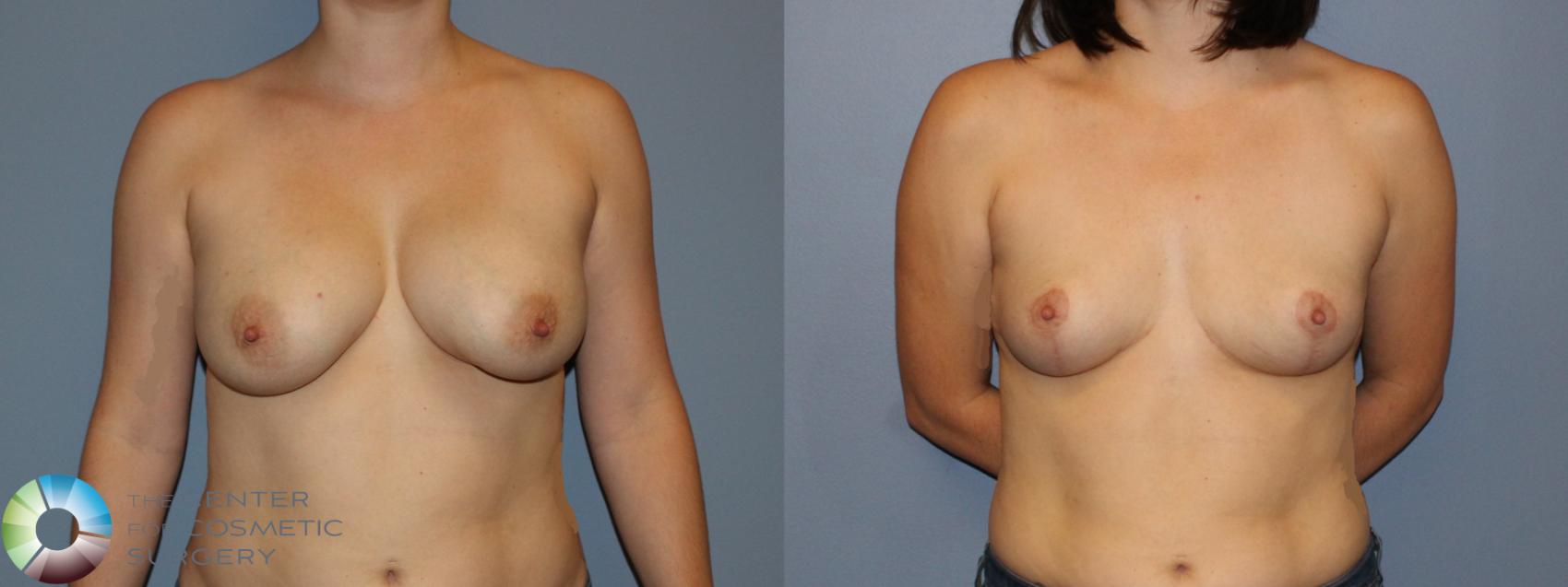 Before & After Breast Lift without Implants Case 11222 Front in Denver and Colorado Springs, CO