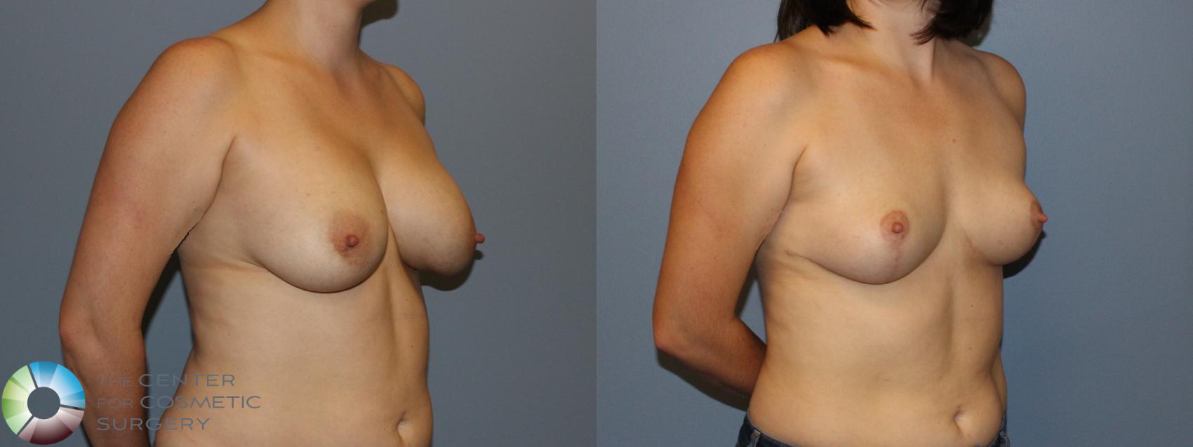 Before & After Breast Implant Removal (Explant) Case 11222 Right Oblique View in Denver & Golden, CO