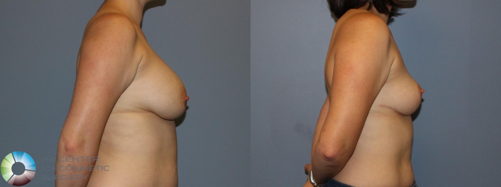 Before & After Breast Implant Removal (Explant) Case 11222 Right Side View in Golden, CO