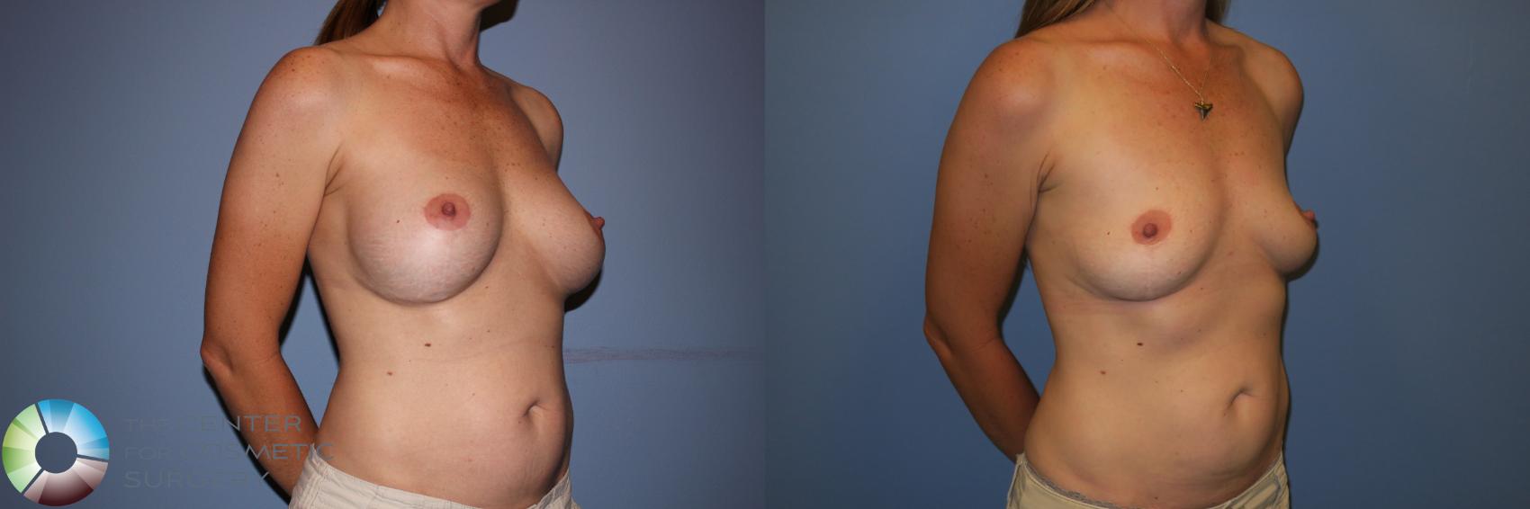 Before & After Breast Implant Removal (Explant) Case 11228 Right Oblique in Denver and Colorado Springs, CO