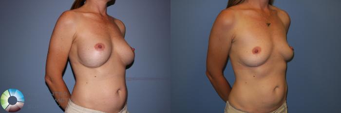 Before & After Breast Implant Removal (Explant) Case 11228 Right Oblique View in Golden, CO