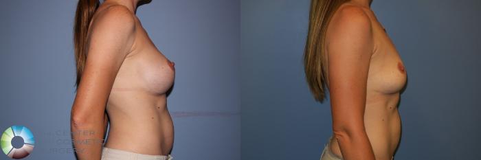 Before & After Breast Implant Removal (Explant) Case 11228 Right Side View in Golden, CO