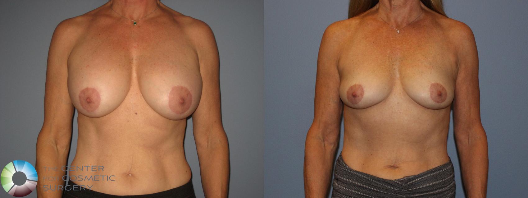 Before & After Breast Implant Removal (Explant) Case 11229 Front in Denver and Colorado Springs, CO