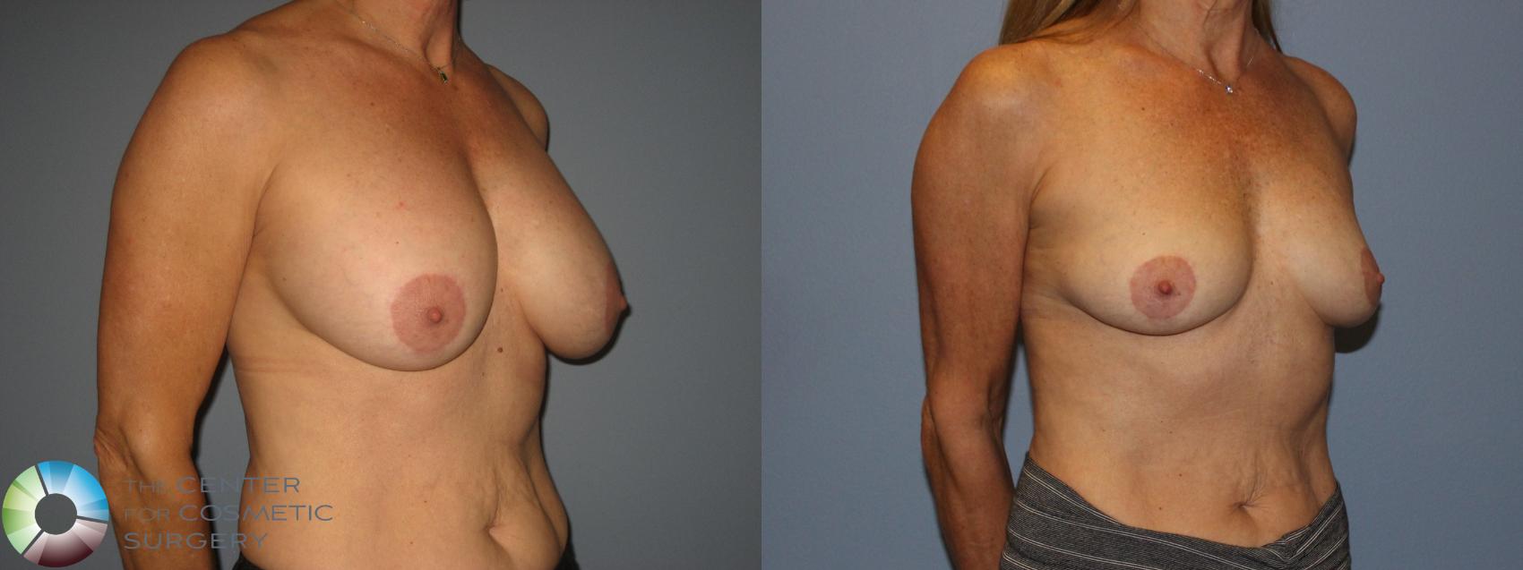 Before & After Breast Implant Removal (Explant) Case 11229 Right Oblique View in Golden, CO