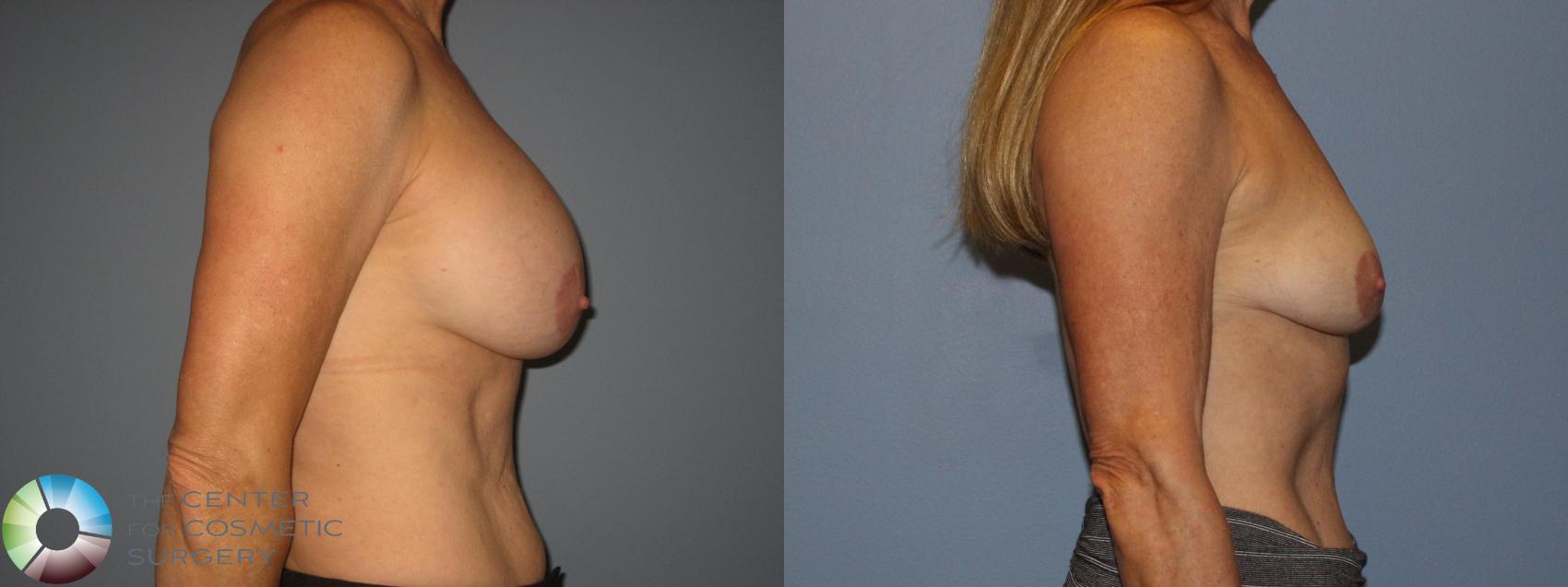 Before & After Breast Implant Removal (Explant) Case 11229 Right Side View in Golden, CO