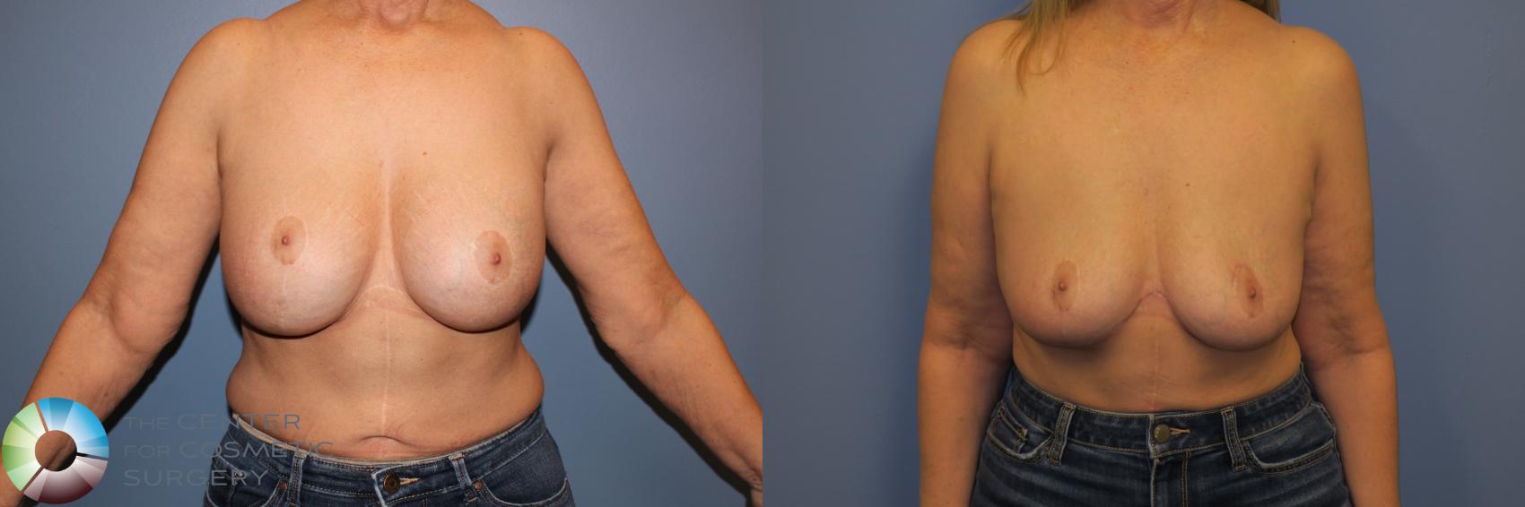 Before & After Breast Implant Removal (Explant) Case 11230 Front View in Golden, CO