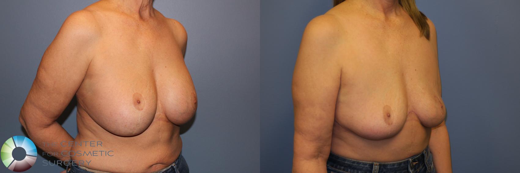 Before & After Breast Implant Removal (Explant) Case 11230 Right Oblique View in Denver & Golden, CO