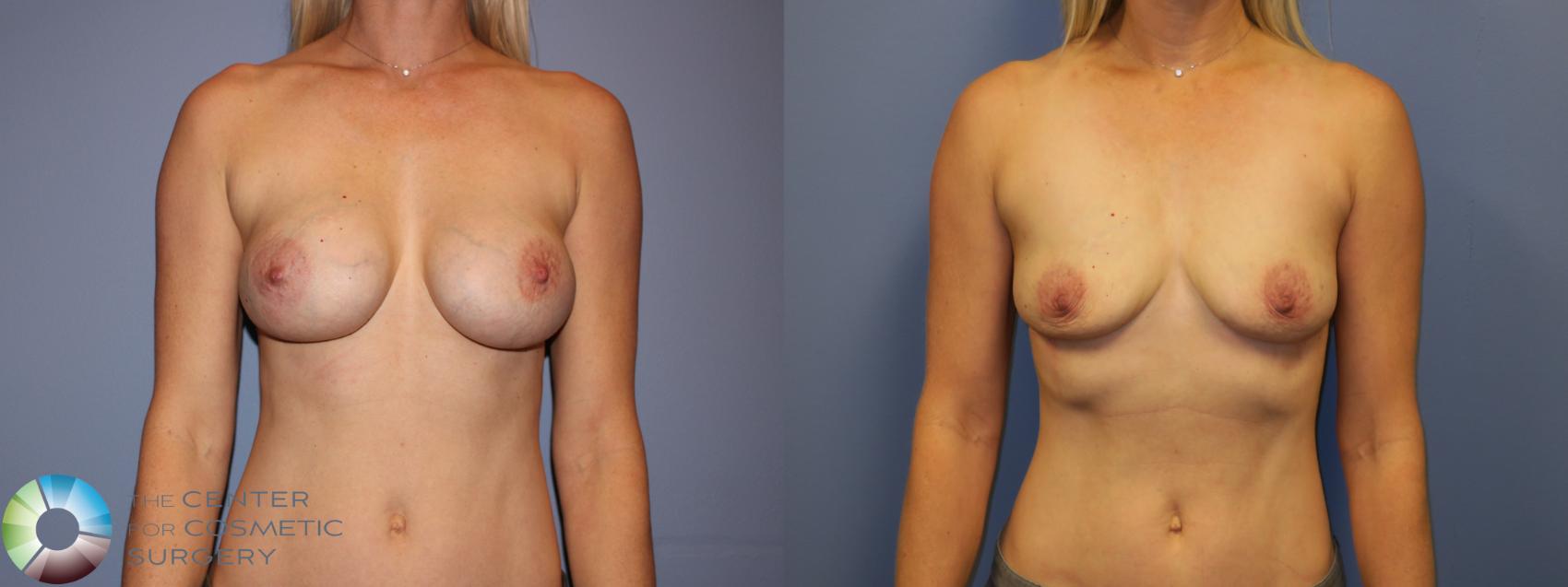 Before & After Breast Implant Removal (Explant) Case 11231 Front in Denver and Colorado Springs, CO