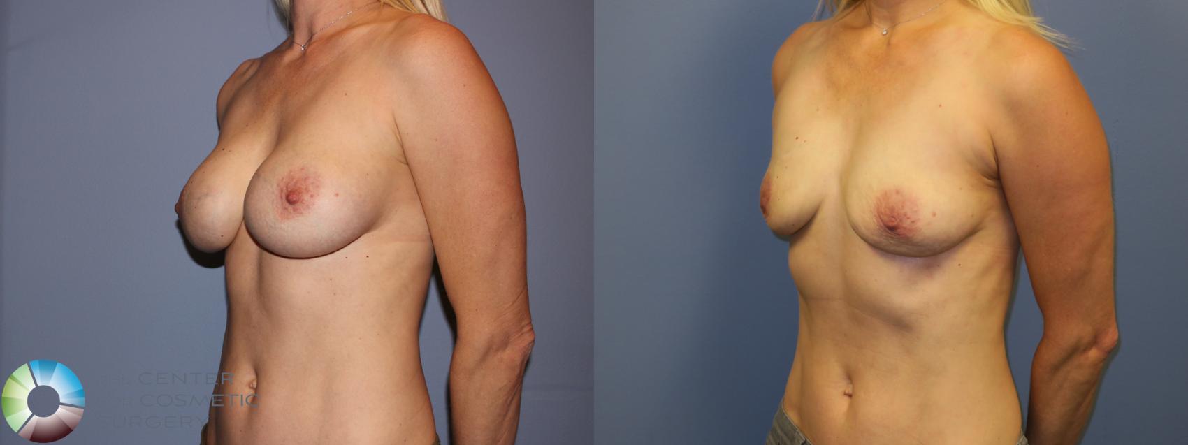 Before & After Breast Implant Removal (Explant) Case 11231 Left Oblique in Denver and Colorado Springs, CO
