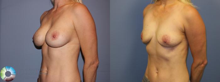 Before & After Breast Implant Removal (Explant) Case 11231 Left Oblique View in Golden, CO