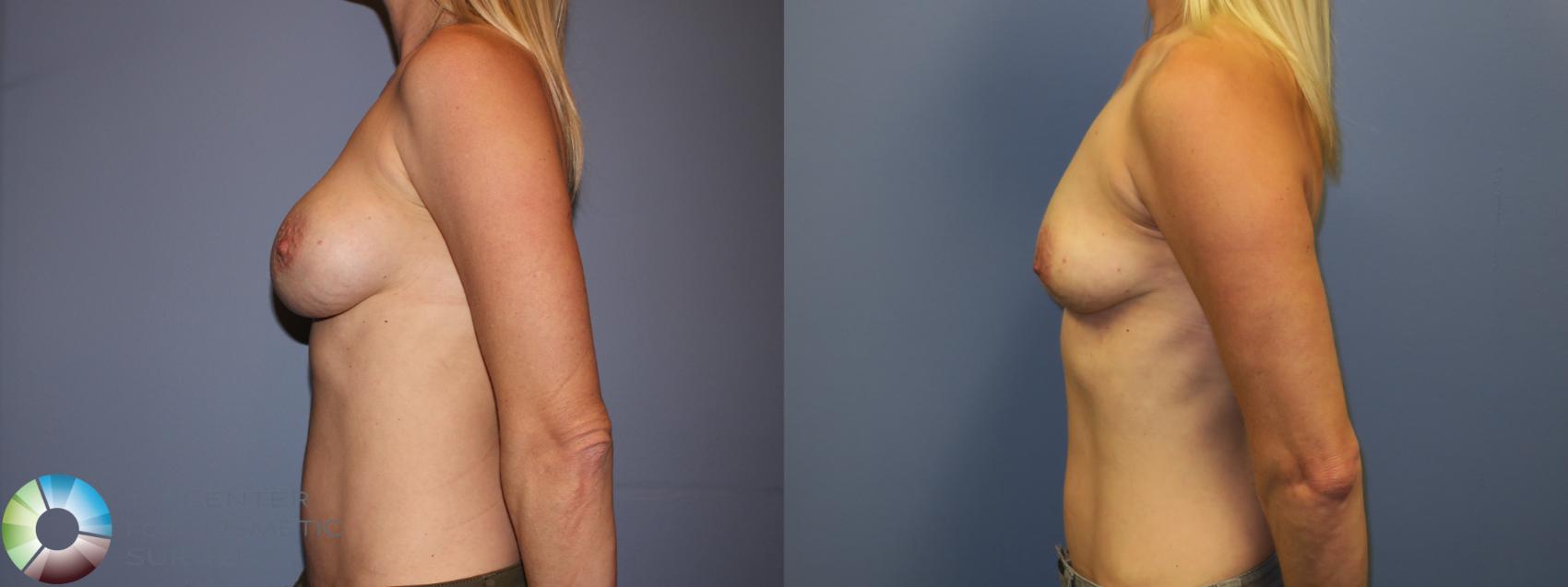 Before & After Breast Implant Removal (Explant) Case 11231 Left Side in Denver and Colorado Springs, CO