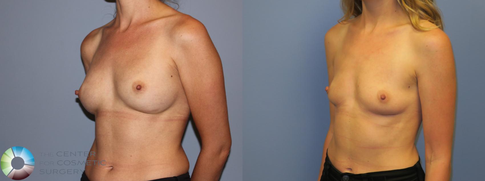 Before & After Breast Implant Removal (Explant) Case 11232 Left Oblique in Denver and Colorado Springs, CO