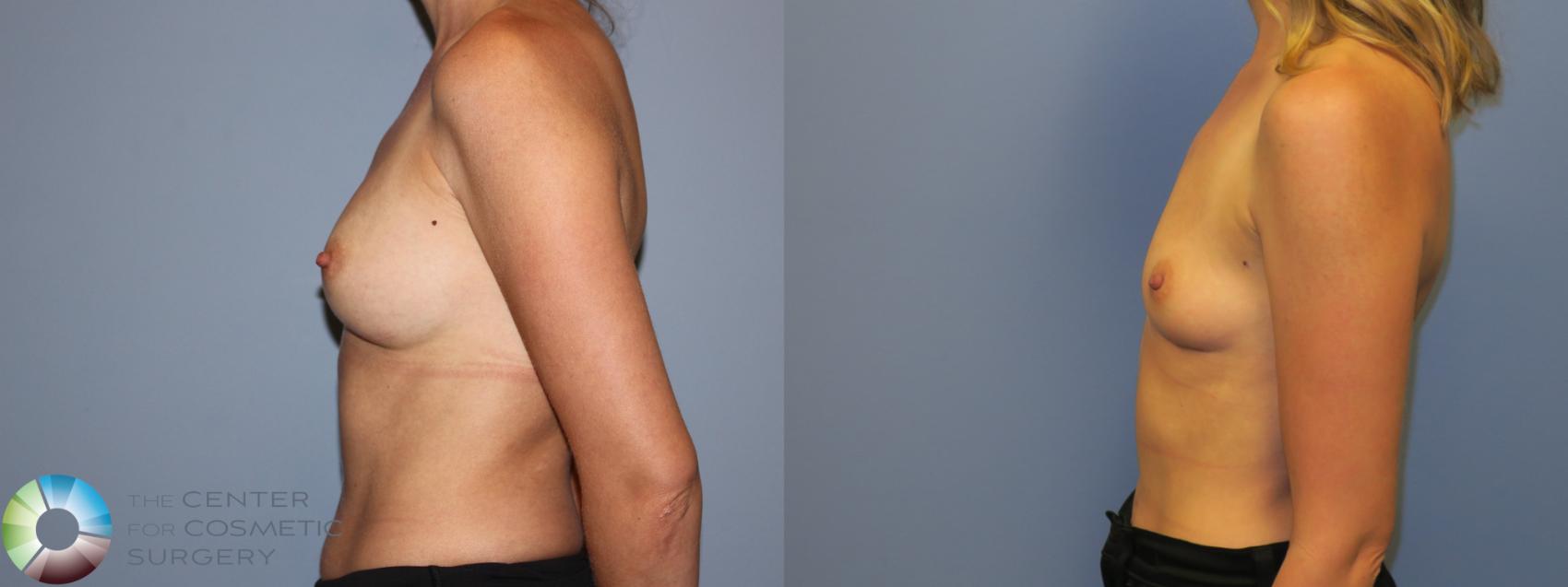 Before & After Breast Implant Removal (Explant) Case 11232 Left Side in Denver and Colorado Springs, CO