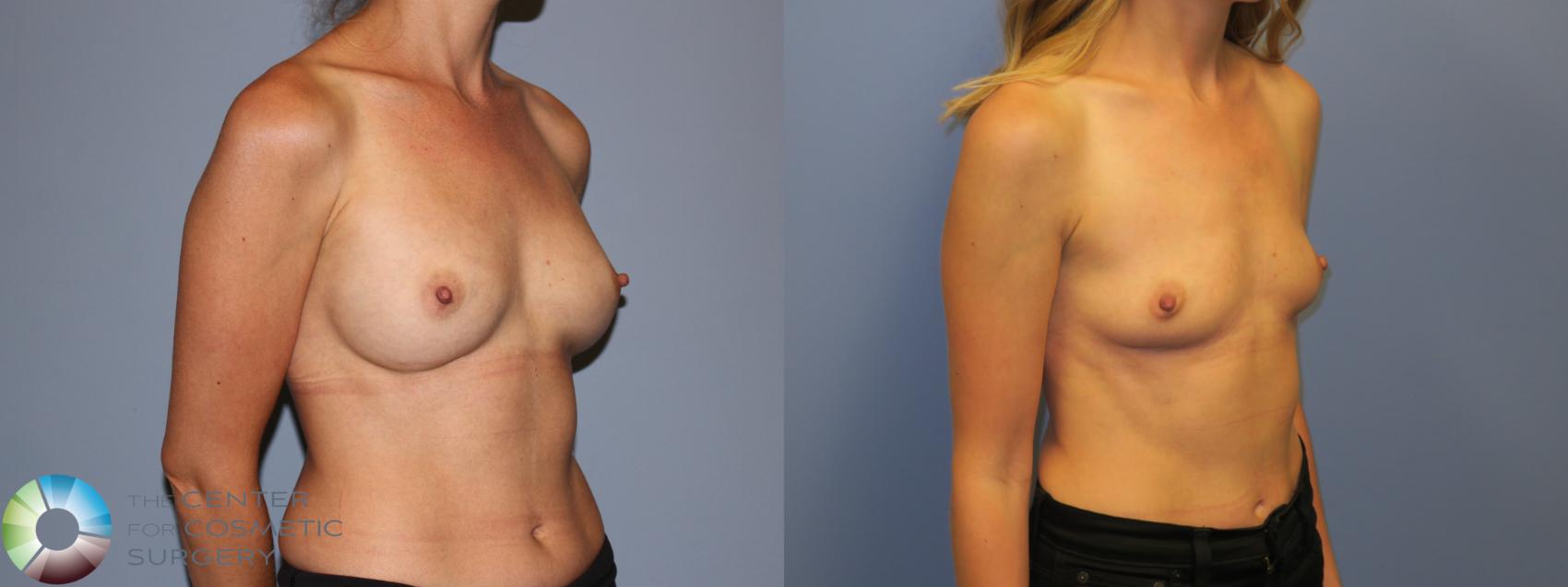 Before & After Breast Implant Removal (Explant) Case 11232 Right Oblique View in Denver & Golden, CO