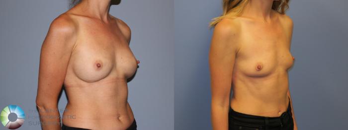 Before & After Breast Implant Removal (Explant) Case 11232 Right Oblique View in Golden, CO