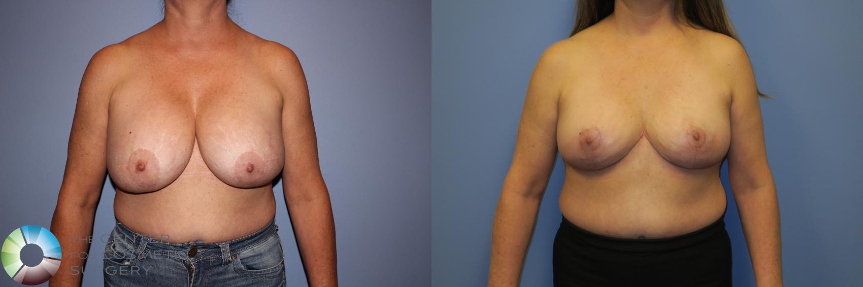 Before & After Breast Implant Removal (Explant) Case 11233 Front in Denver and Colorado Springs, CO