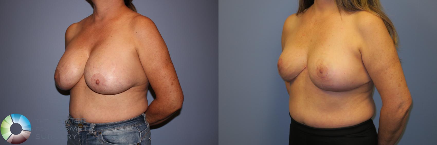 Before & After Breast Implant Removal (Explant) Case 11233 Left Oblique in Denver and Colorado Springs, CO