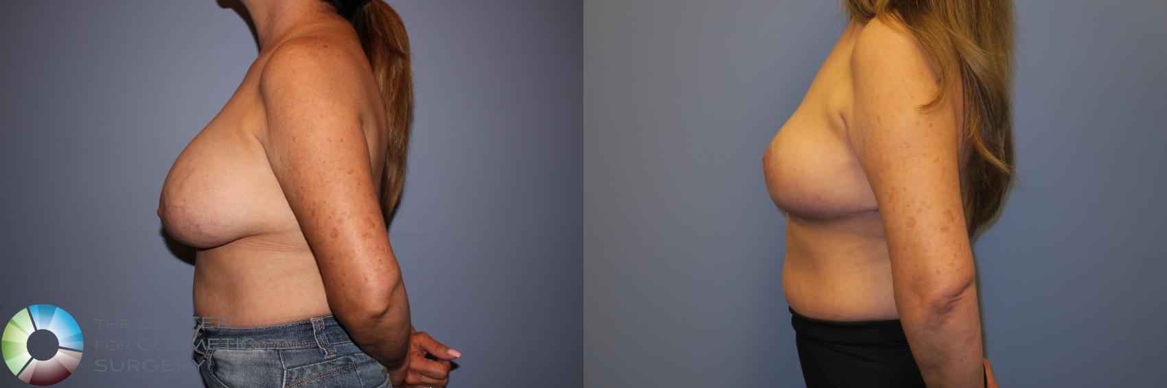 Before & After Breast Implant Removal (Explant) Case 11233 Left Side in Denver and Colorado Springs, CO