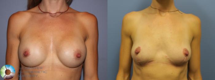 Before & After Breast Implant Removal (Explant) Case 11651 Front in Denver and Colorado Springs, CO