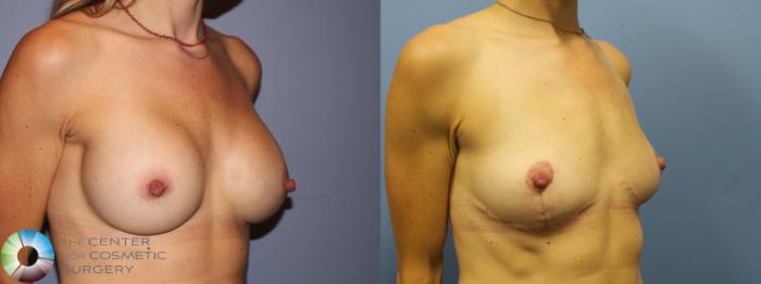 Before & After Breast Implant Removal (Explant) Case 11651 Right Oblique in Denver and Colorado Springs, CO