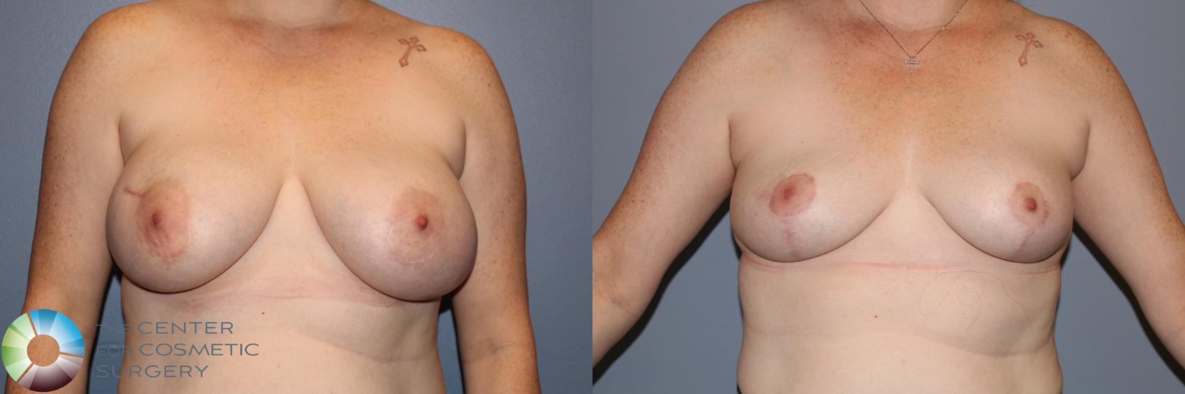 Before & After Breast Implant Removal (Explant) Case 11900 Front in Denver, CO