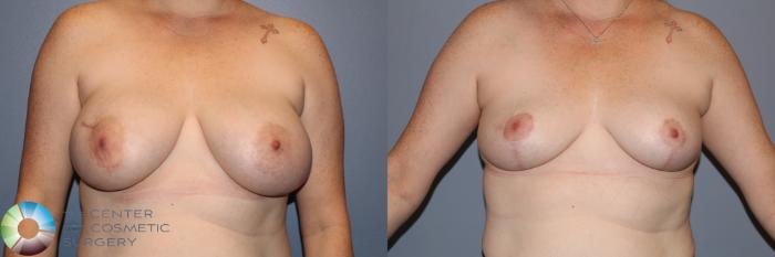 Before & After Breast Implant Removal (Explant) Case 11900 Front View in Golden, CO
