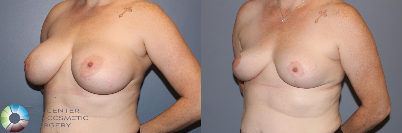 Before & After Breast Implant Removal (Explant) Case 11900 Left Oblique in Denver and Colorado Springs, CO