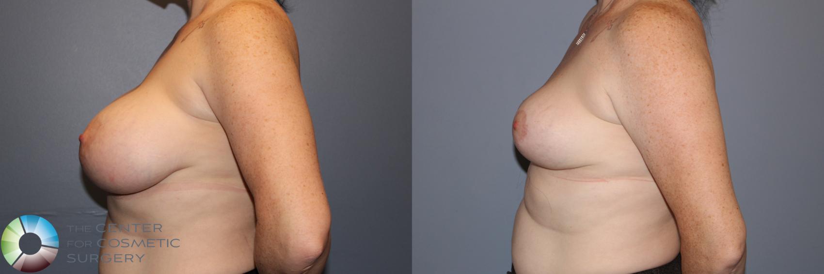 Before & After Breast Implant Removal (Explant) Case 11900 Left Side in Denver and Colorado Springs, CO