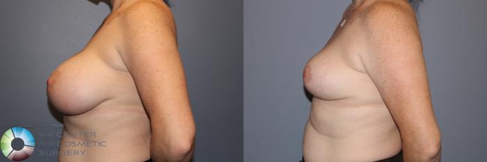 Before & After Breast Implant Removal (Explant) Case 11900 Left Side in Denver, CO