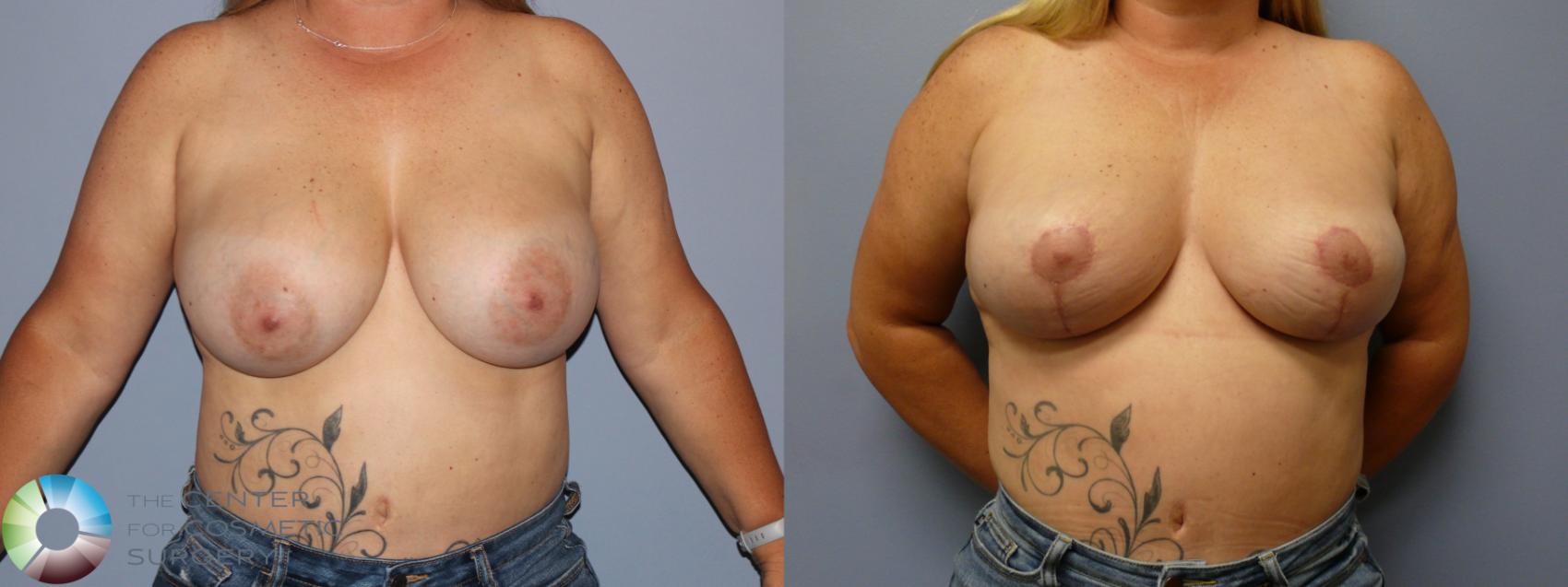 Before & After Breast Lift Case 11923 Front in Denver and Colorado Springs, CO