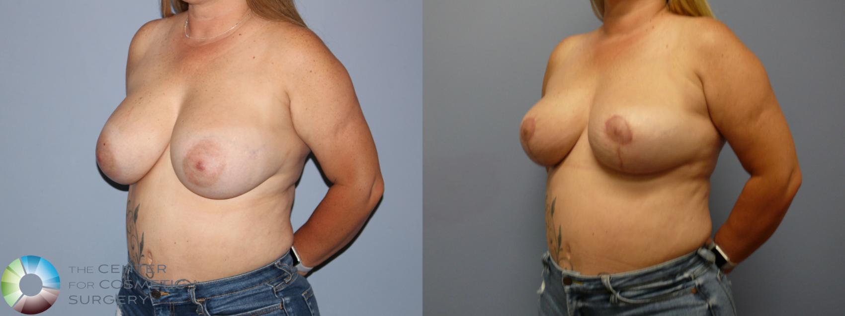 Before & After Breast Implant Removal (Explant) Case 11923 Left Oblique in Denver and Colorado Springs, CO