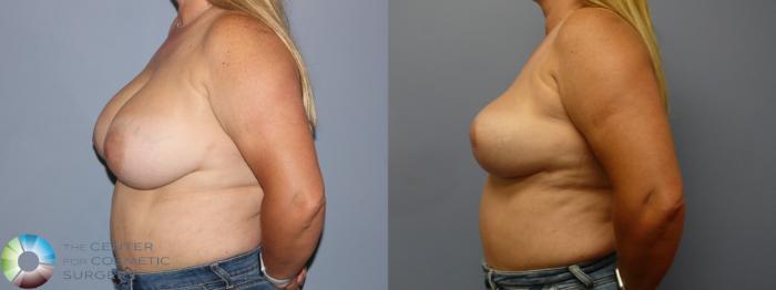 Before & After Breast Implant Removal (Explant) Case 11923 Left Side in Denver and Colorado Springs, CO