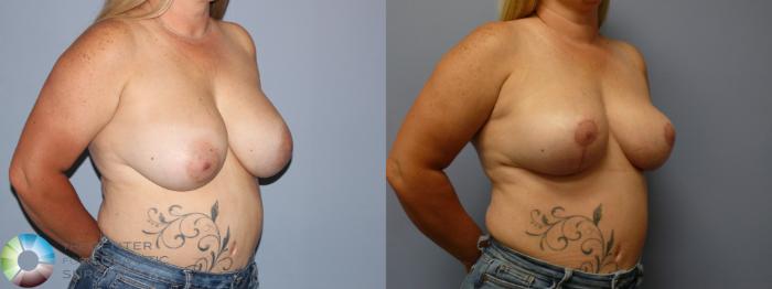 Before & After Breast Lift Case 11923 Right Oblique in Denver and Colorado Springs, CO